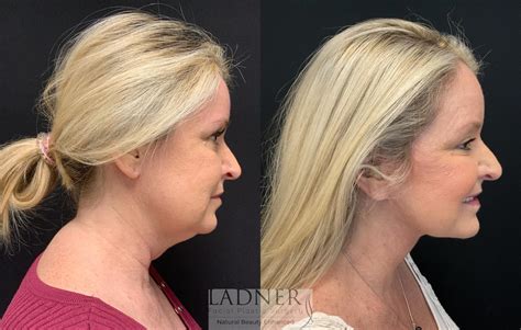 Facelift Neck Lift Before And After Pictures Case 164 Denver Co Ladner Facial Plastic Surgery