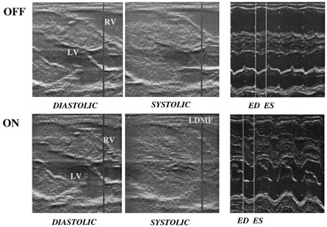 Configuration Of Linear Dynamic Cardiomyoplasty For Hypoplastic Right