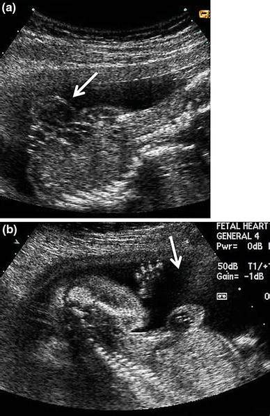 A B Complete Thoracic Ectopia Cordis Fetal Echocardiography At
