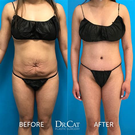 What Is The Difference Between Lipo And Tummy Tuck Cosmetic