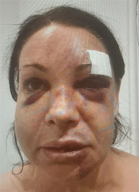 See Horrific Injuries Mum Who Committed Suicide Suffered