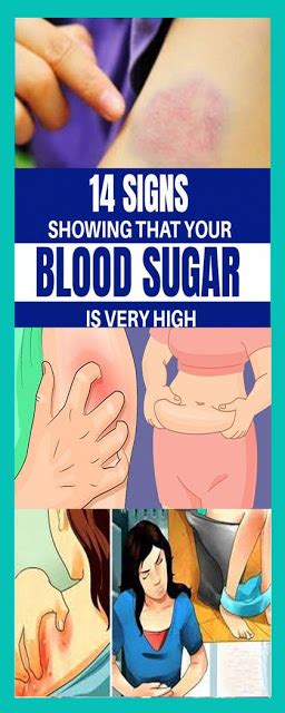Signs Showing That Your Blood Sugar Is Very High Medicine Health Life