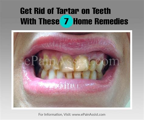 Here you may to know how to rid calcium deposits. Get Rid of Tartar on Teeth With These 7 Home Remedies