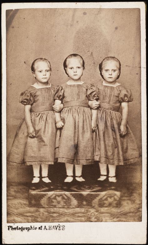 Conjoined Triplets Photos