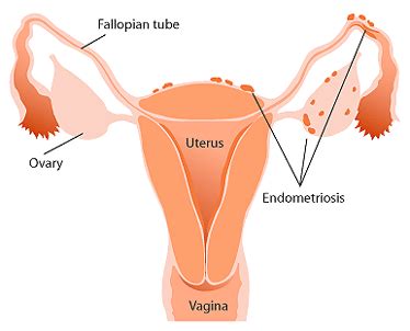 Tentang Endometriosis