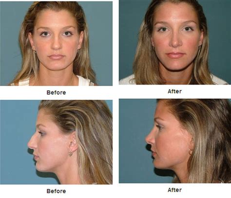 Tip Of Nose Surgery Before And After Before And After