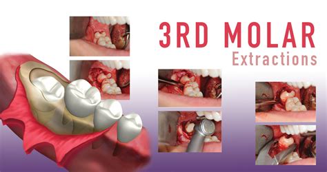 Third Molar Extractions A Hands On Live Patient Course Course Karma