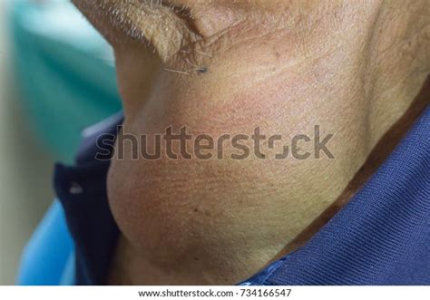Zooming Closeup View Enlarged Thyroid Goiter Stock Photo Edit Now