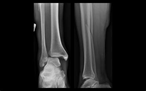 Fracture Fibula Disruption Ankle And Distal Tibiofibular Flickr
