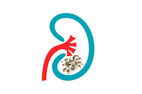 Kidney Stones Types Causes And The Right Treatment Regency Hospital