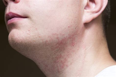 Irritation After Shaving On The Neck Of A Man Close Up Stock Image