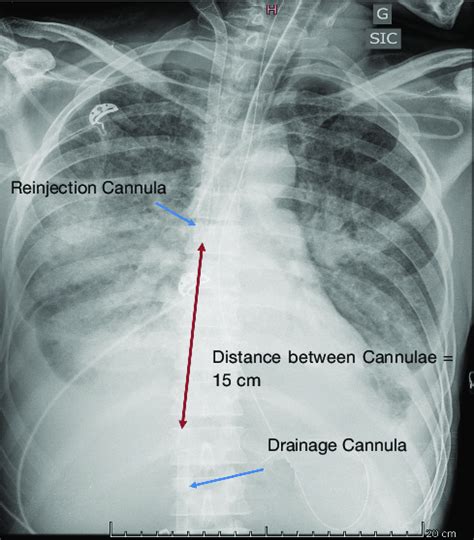 Chest X Ray Showing The Correct Distance Between Drainage And