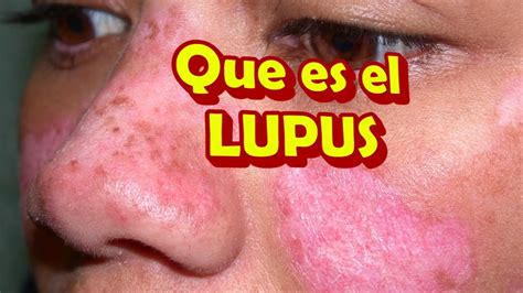 Que Es El Lupus Y Sus Sintomas Como Se Manifiesta Y Como