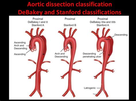 Acute Aortic Syndrome