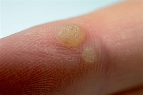 Collection Of Wart Like Bumps On Skin Treatment Of Flat Wart How To