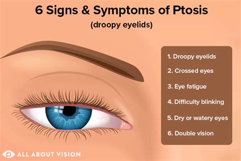 Ptosis Droopy Eyelids All About Vision