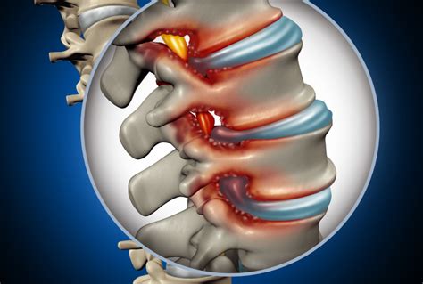 What Is Nerve Compression Syndrome In The Back
