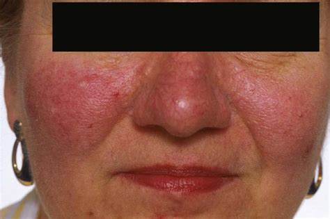 Rosacea And Acne Treatment Dorothee Padraig South West Skin Health Care