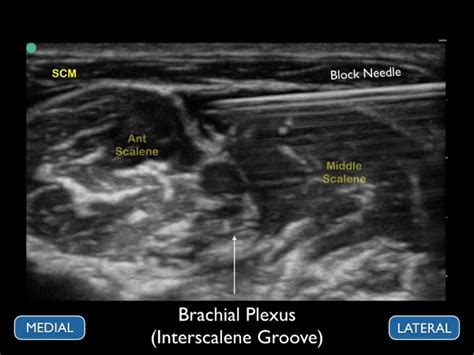 Ultrasound Guided Nerve Blocks Emra