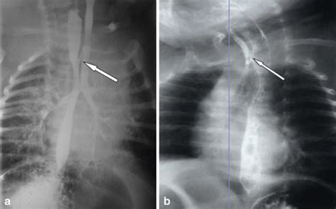 Esophageal Atresia With Distal Tracheo Esophageal Fistula Pacs The Best Porn Website