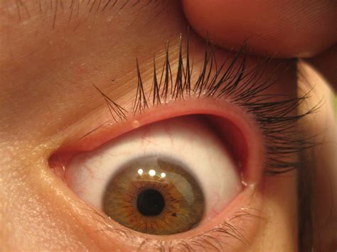 Tiny Blister On Inner Eyelid Roptometry