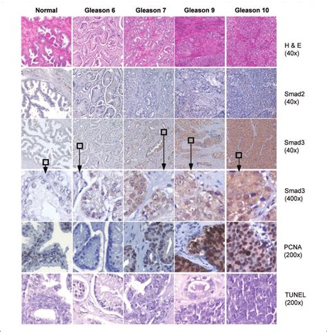 Immunohistochemistry and TUNEL staining of the tissue arrays of human 
