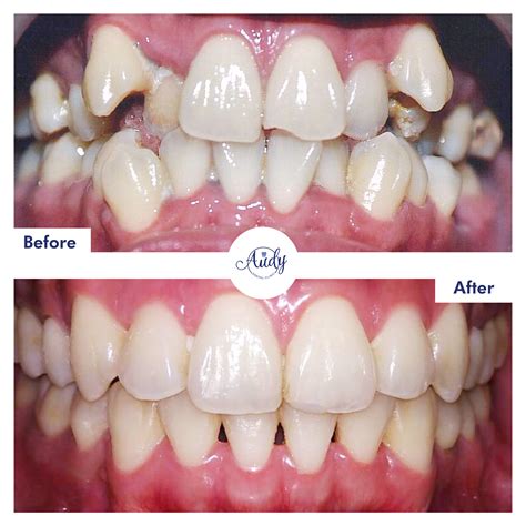 Behel Gigi | Audy Dental