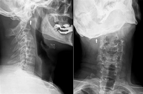 A Forty Two Year Old Man With Neck Pain And Abnormal Upper Cervical