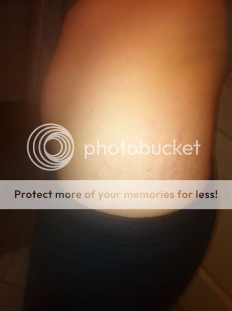What Do Your Stretch Marks Look Like Now Babycenter