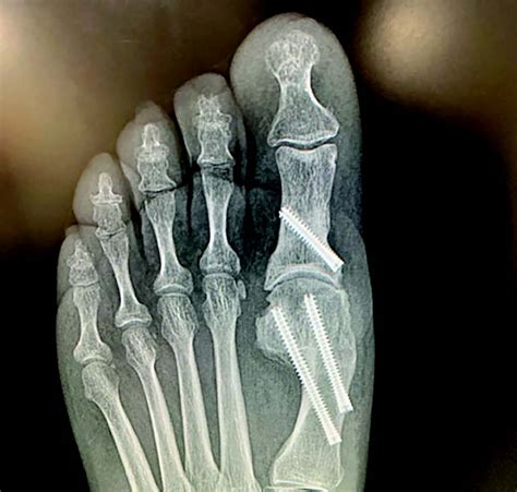 Roundtable Insights On Minimally Invasive Bunion Surgery