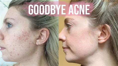 Ultimate Acne Clearing Tips Youtube