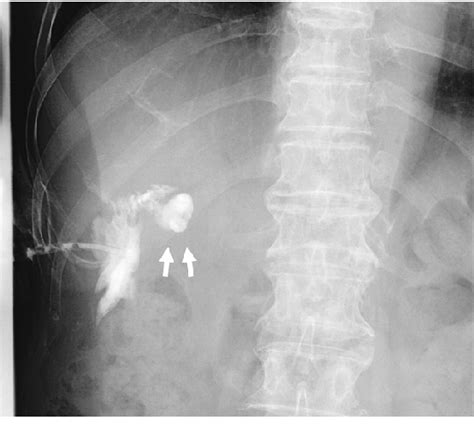 Figure From A Case Of Cholecystocutaneous Fistula With Extrahepatic
