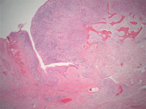 Recurrent Peripheral Giant Cell Granuloma A Case Report My XXX Hot Girl