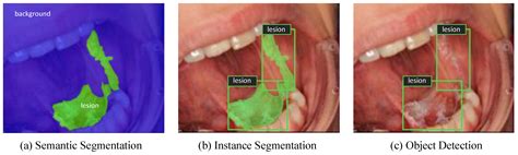 Cancers Free Full Text Automated Detection And Classification Of Oral Lesions Using Deep