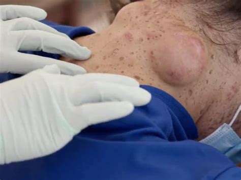 Dr Pimple Popper The Best Pimple Popping Videos Of 2021