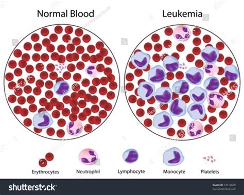 Leukemic Versus Normal Blood Great Details Stock Vector 73619680