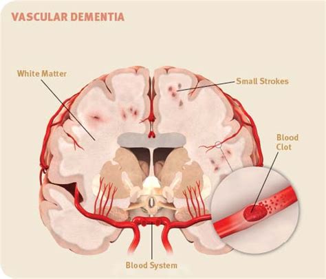 Dementia 101 Know The Different Types Of Dementia