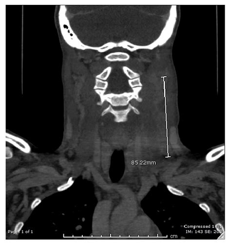 Computed Tomography Ct Scan Sagittal View Neck With Contrast