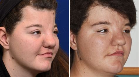 Plastic Surgery Case Study Forehead Reconstruction With