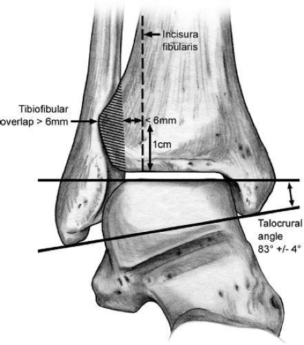 Ankle Fractures Open Reduction Internal Fixation Musculoskeletal Key