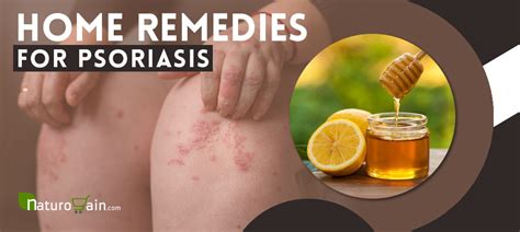 10 Best Home Remedies For Psoriasis That You Need To Know