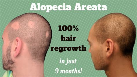 How I Healed My Alopecia Areata And Regrew My Hair In 9 Months Youtube