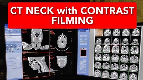 Neck Ct Scan Filming Protocol Youtube