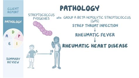 Rheumatic Fever Pathogenesis
