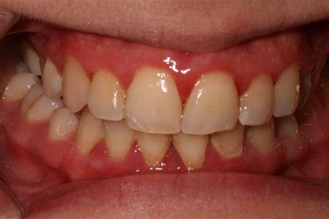 Gum Disease Pictures What Do Healthy Gums Look Like Crest Ca