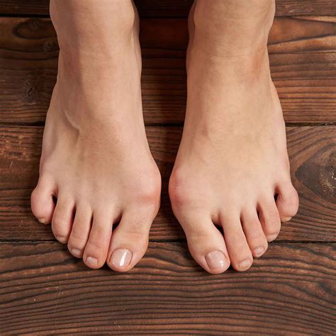 What Are The Risks Of Bunion Surgery