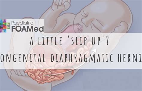 A Little ‘slip Up Congenital Diaphragmatic Hernia Paediatricfoam