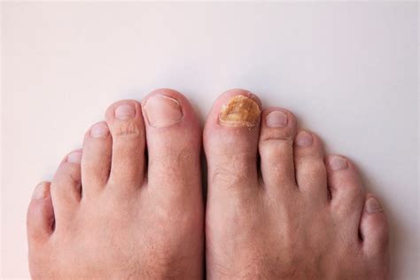 What Causes Toenail Fungus And How Can It Be Treated Arizona Foot Doctors