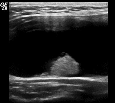 Illustrates Cystic Lesion With Mural Nodule The Mural Nodule Has A