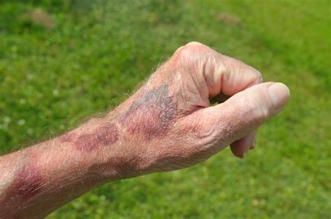 Seniors Find Help For Frequent Bruising Audacious You
